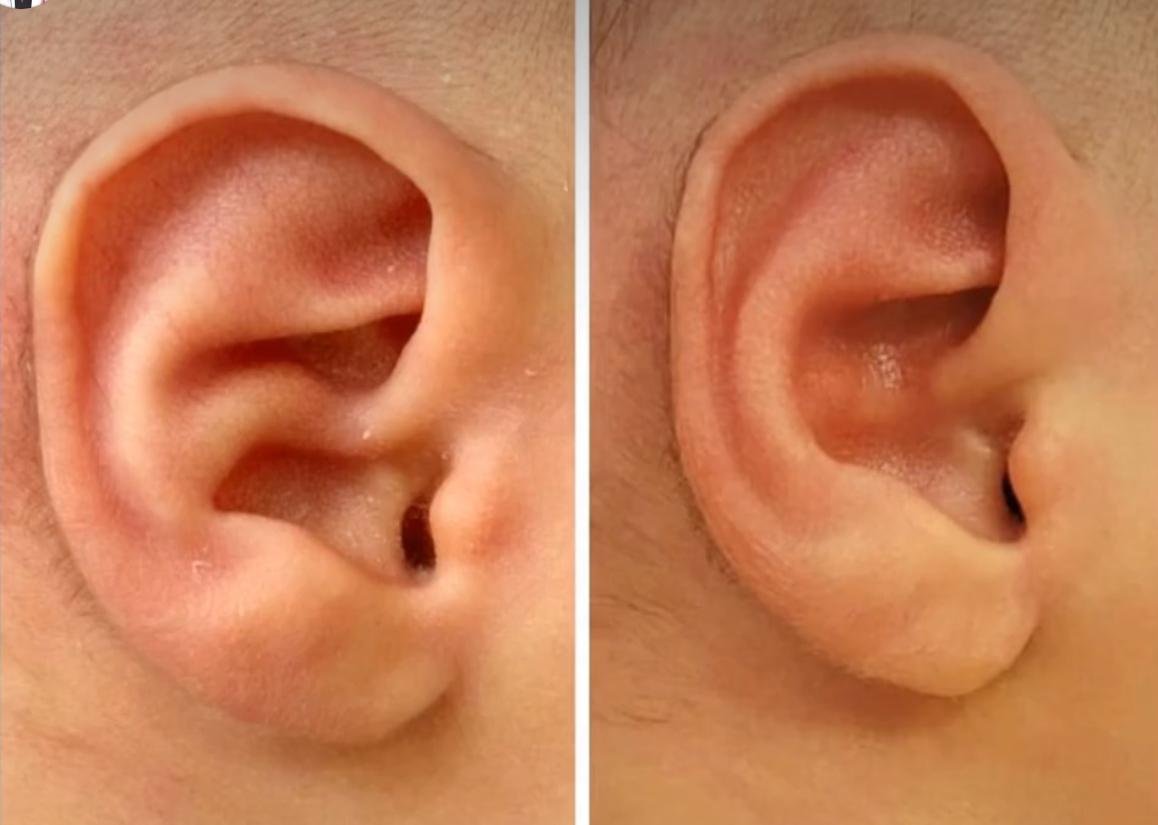 Kulak Şekil Bozukluğu Tedavisi